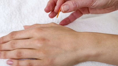 Acupuncture